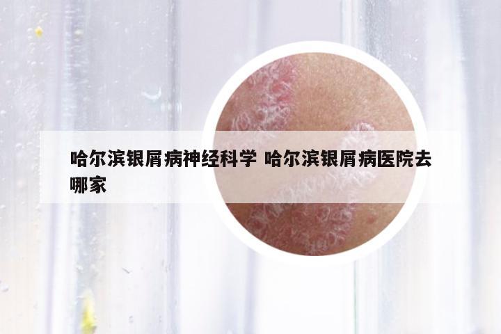 哈爾濱銀屑病神經(jīng)科學(xué) 哈爾濱銀屑病醫(yī)院去哪家