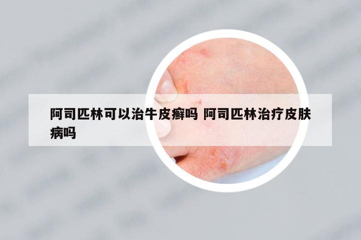 阿司匹林可以治牛皮癬嗎 阿司匹林治療皮膚病嗎