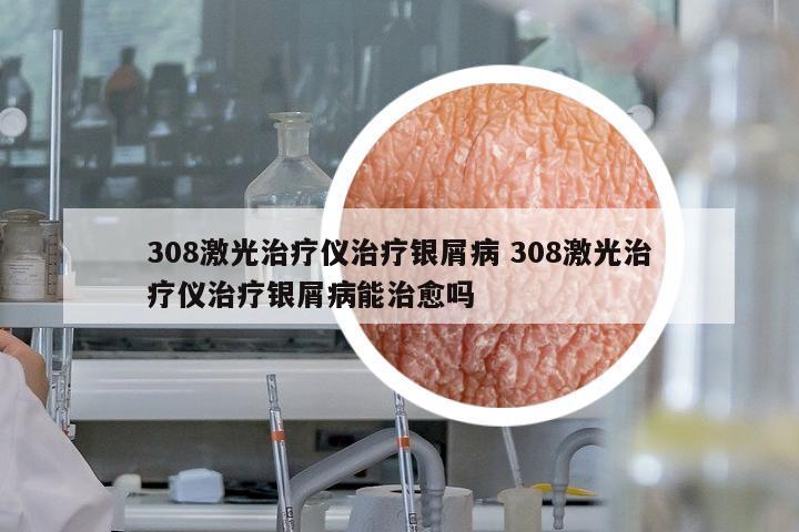 308激光治療儀治療銀屑病 308激光治療儀治療銀屑病能治愈嗎