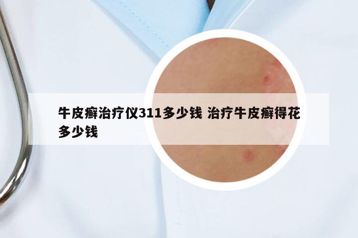 牛皮癬治療儀311多少錢 治療牛皮癬得花多少錢