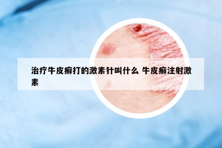 治療牛皮癬打的激素針叫什么 牛皮癬注射激素