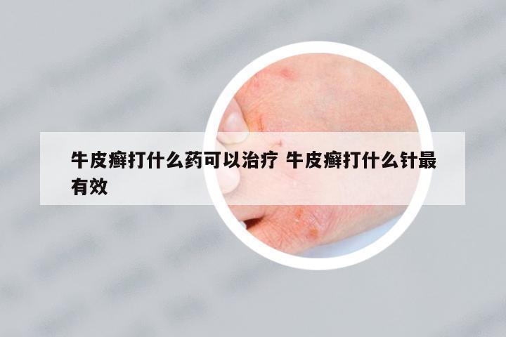 牛皮癬打什么藥可以治療 牛皮癬打什么針最有效