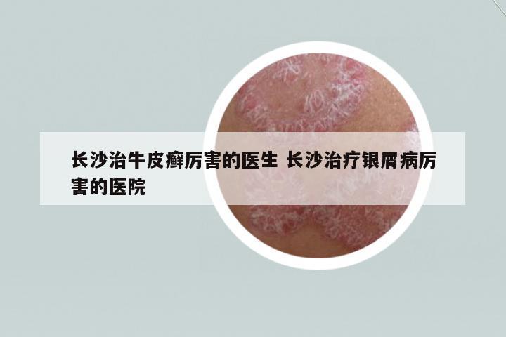 長沙治牛皮癬厲害的醫(yī)生 長沙治療銀屑病厲害的醫(yī)院