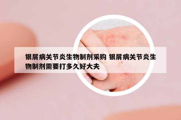 銀屑病關(guān)節(jié)炎生物制劑采購(gòu) 銀屑病關(guān)節(jié)炎生物制劑需要打多久好大夫