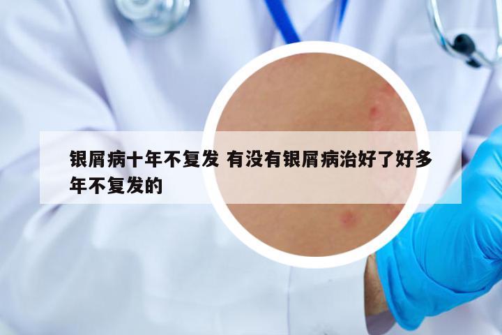 銀屑病十年不復(fù)發(fā) 有沒有銀屑病治好了好多年不復(fù)發(fā)的
