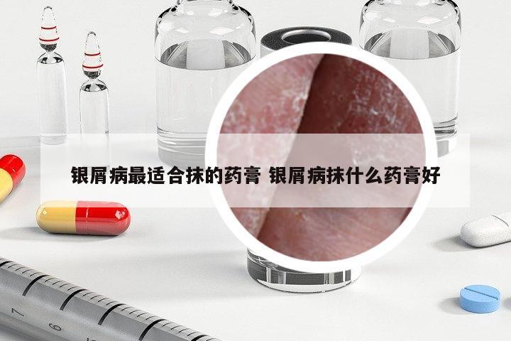 銀屑病最適合抹的藥膏 銀屑病抹什么藥膏好
