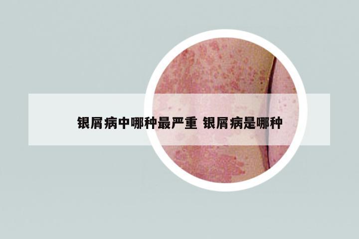 銀屑病中哪種最嚴(yán)重 銀屑病是哪種