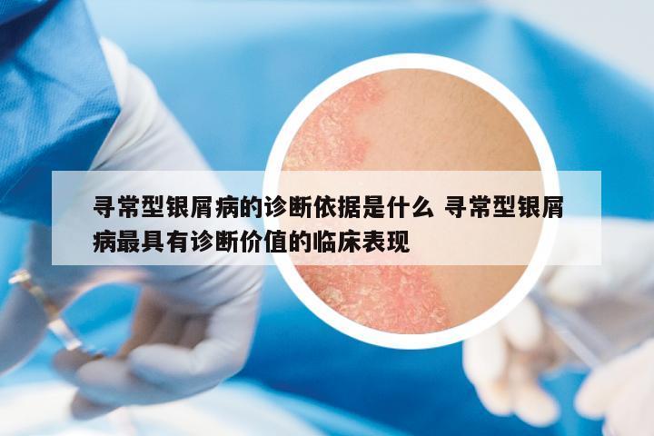 尋常型銀屑病的診斷依據(jù)是什么 尋常型銀屑病最具有診斷價(jià)值的臨床表現(xiàn)