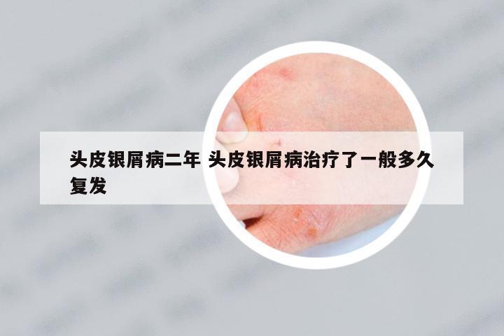 頭皮銀屑病二年 頭皮銀屑病治療了一般多久復(fù)發(fā)