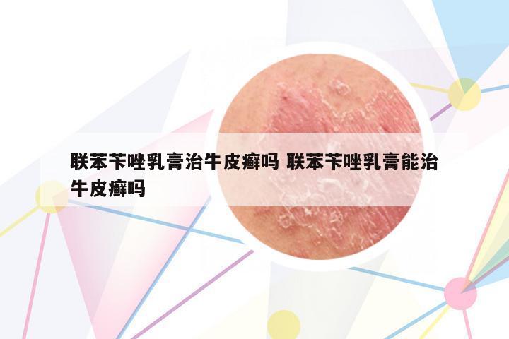 聯(lián)苯芐唑乳膏治牛皮癬嗎 聯(lián)苯芐唑乳膏能治牛皮癬嗎