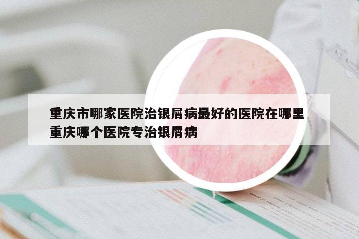 重慶市哪家醫(yī)院治銀屑病最好的醫(yī)院在哪里 重慶哪個(gè)醫(yī)院專治銀屑病