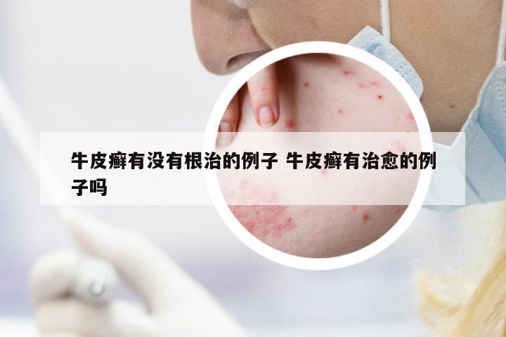 牛皮癬有沒(méi)有根治的例子 牛皮癬有治愈的例子嗎