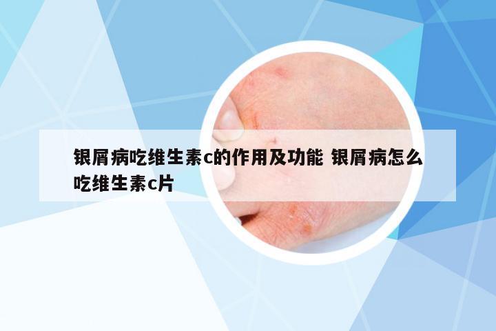 銀屑病吃維生素c的作用及功能 銀屑病怎么吃維生素c片