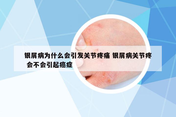 銀屑病為什么會引發(fā)關(guān)節(jié)疼痛 銀屑病關(guān)節(jié)疼 會不會引起癌癥