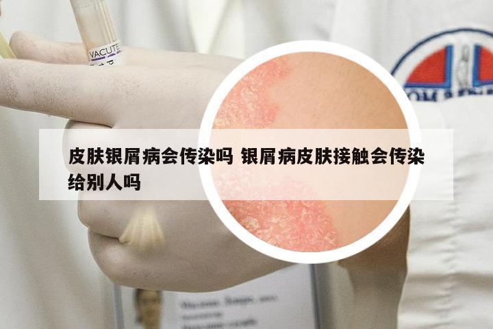 皮膚銀屑病會傳染嗎 銀屑病皮膚接觸會傳染給別人嗎