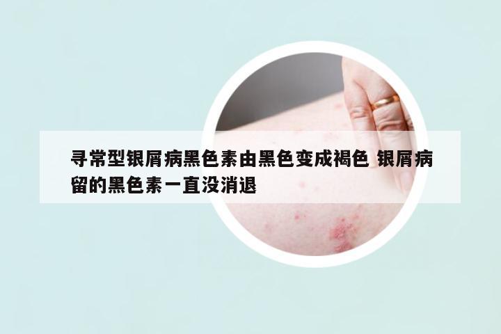 尋常型銀屑病黑色素由黑色變成褐色 銀屑病留的黑色素一直沒消退