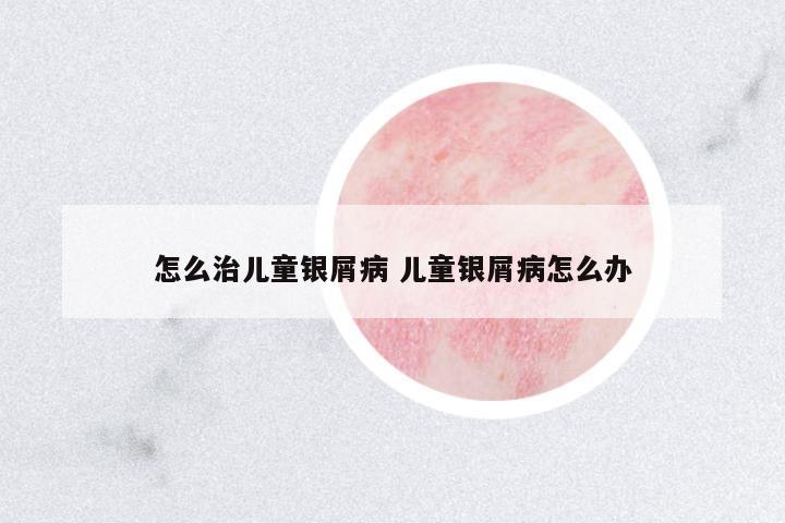 怎么治兒童銀屑病 兒童銀屑病怎么辦