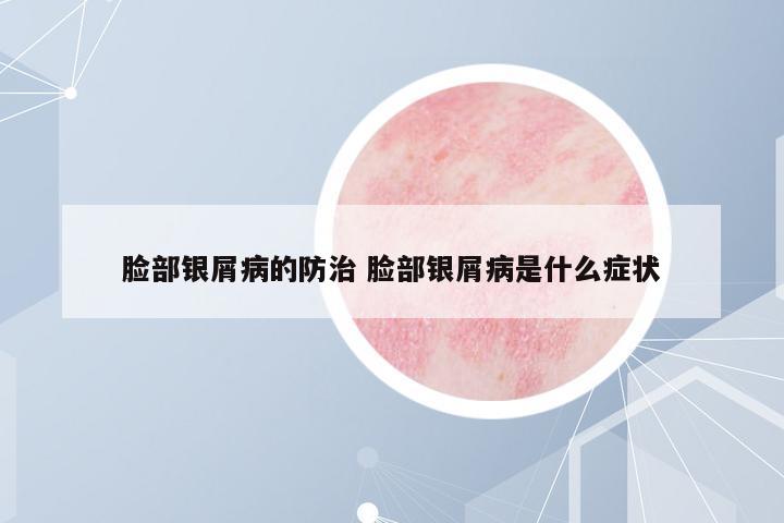 臉部銀屑病的防治 臉部銀屑病是什么癥狀