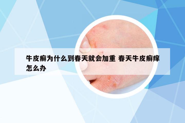 牛皮癬為什么到春天就會(huì)加重 春天牛皮癬癢怎么辦