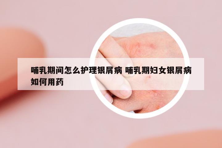 哺乳期間怎么護理銀屑病 哺乳期婦女銀屑病如何用藥