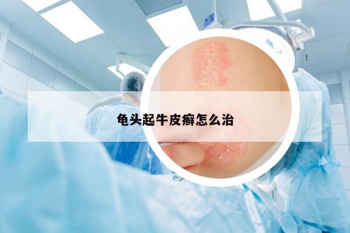 龜頭起牛皮癬怎么治