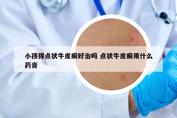 小孩得點(diǎn)狀牛皮癬好治嗎 點(diǎn)狀牛皮癬用什么藥膏