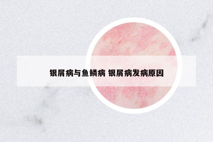 銀屑病與魚鱗病 銀屑病發(fā)病原因