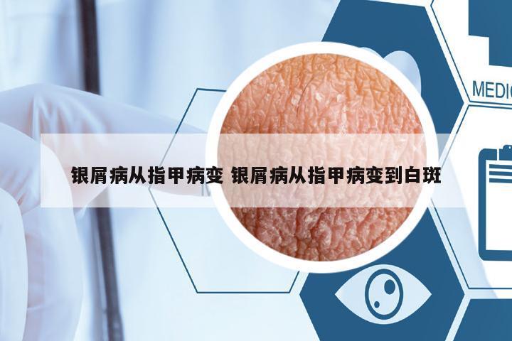 銀屑病從指甲病變 銀屑病從指甲病變到白斑