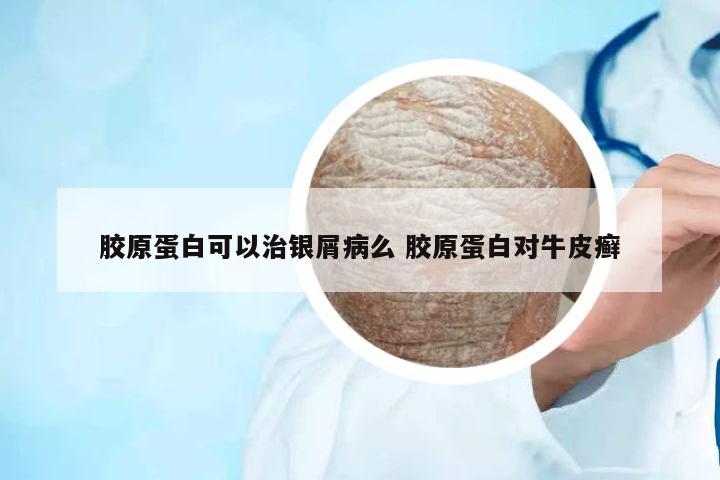 膠原蛋白可以治銀屑病么 膠原蛋白對牛皮癬