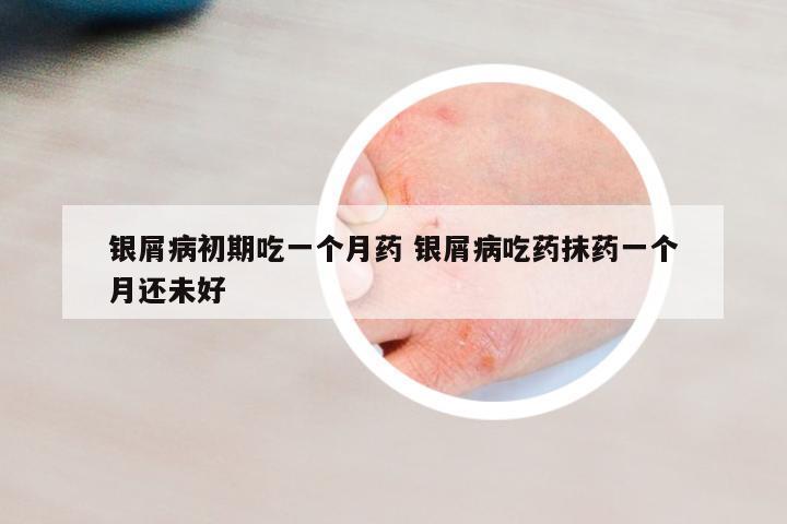 銀屑病初期吃一個月藥 銀屑病吃藥抹藥一個月還未好