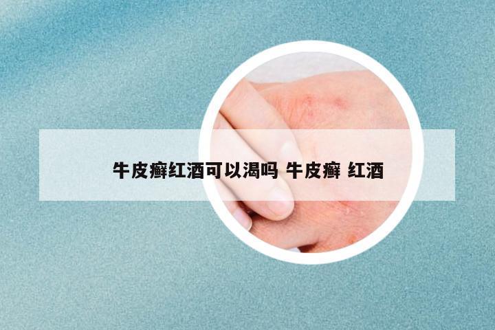 牛皮癬紅酒可以渴嗎 牛皮癬 紅酒