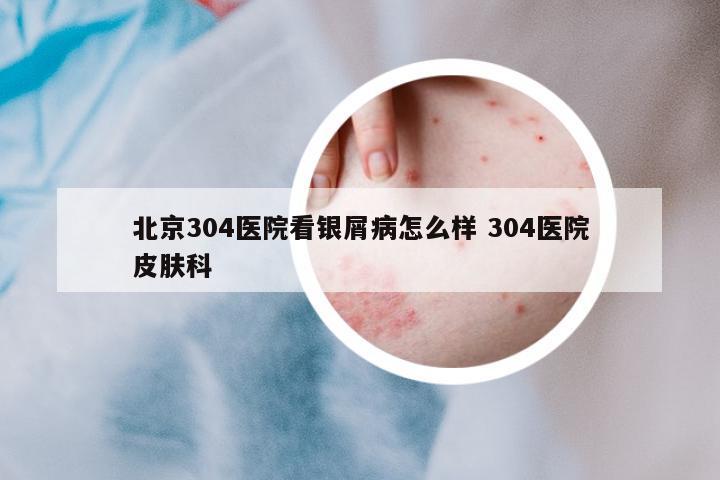 北京304醫(yī)院看銀屑病怎么樣 304醫(yī)院皮膚科