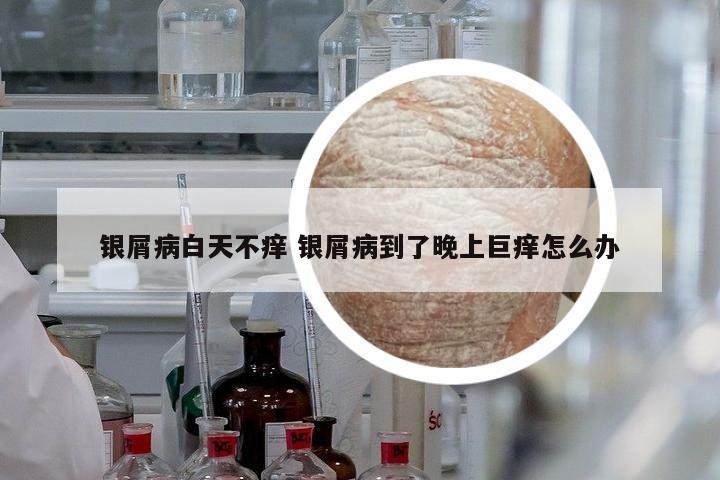 銀屑病白天不癢 銀屑病到了晚上巨癢怎么辦