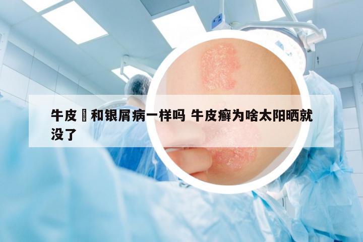 牛皮癬和銀屑病一樣嗎 牛皮癬為啥太陽曬就沒了