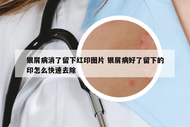 銀屑病消了留下紅印圖片 銀屑病好了留下的印怎么快速去除