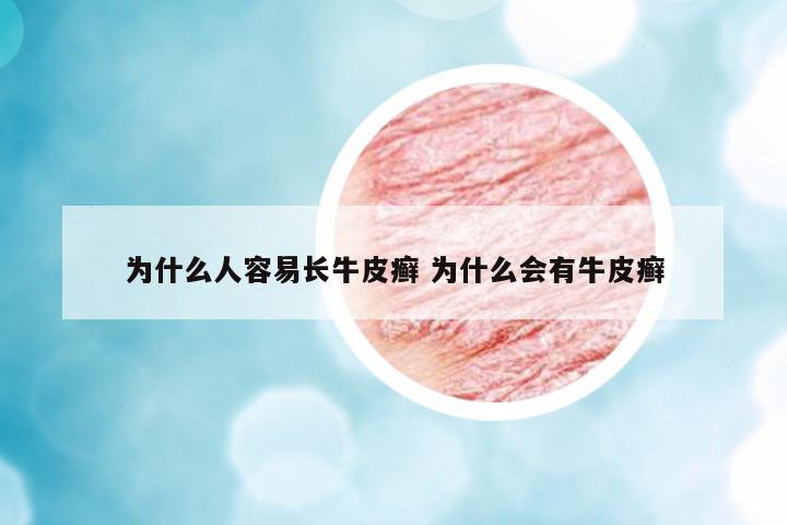 為什么人容易長牛皮癬 為什么會有牛皮癬