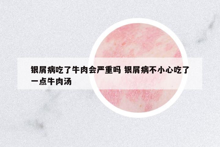 銀屑病吃了牛肉會嚴重嗎 銀屑病不小心吃了一點牛肉湯