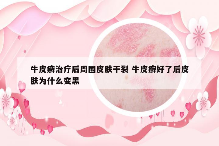 牛皮癬治療后周圍皮膚干裂 牛皮癬好了后皮膚為什么變黑