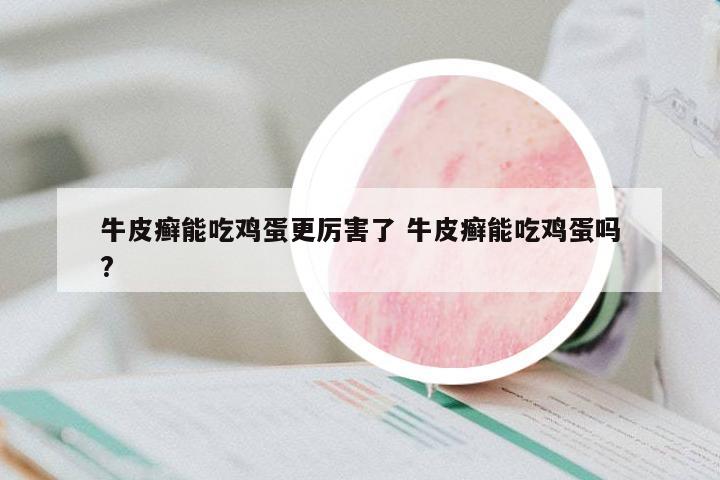 牛皮癬能吃雞蛋更厲害了 牛皮癬能吃雞蛋嗎?