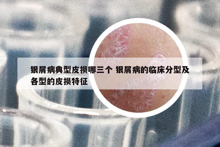 銀屑病典型皮損哪三個 銀屑病的臨床分型及各型的皮損特征
