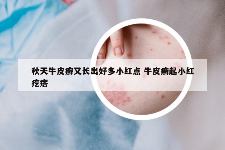 秋天牛皮癬又長出好多小紅點 牛皮癬起小紅疙瘩