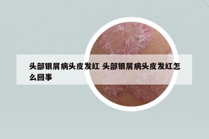 頭部銀屑病頭皮發(fā)紅 頭部銀屑病頭皮發(fā)紅怎么回事