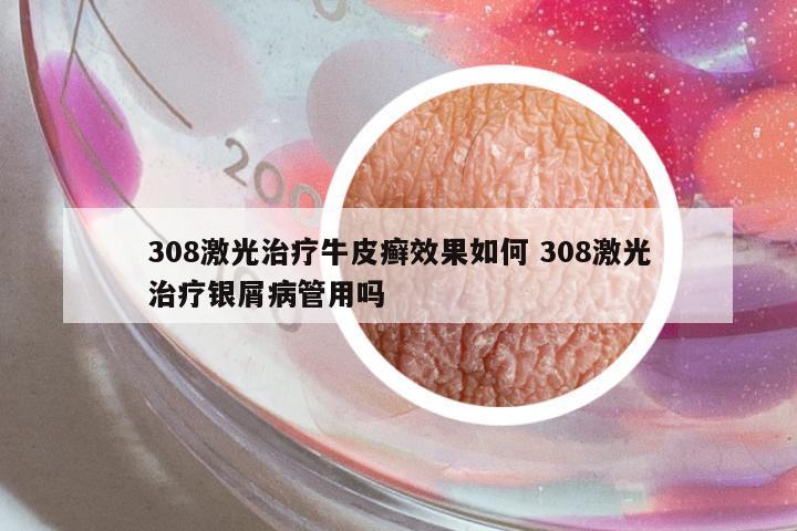 308激光治療牛皮癬效果如何 308激光治療銀屑病管用嗎