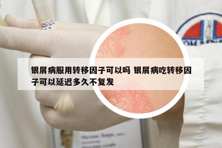 銀屑病服用轉(zhuǎn)移因子可以嗎 銀屑病吃轉(zhuǎn)移因子可以延遲多久不復(fù)發(fā)