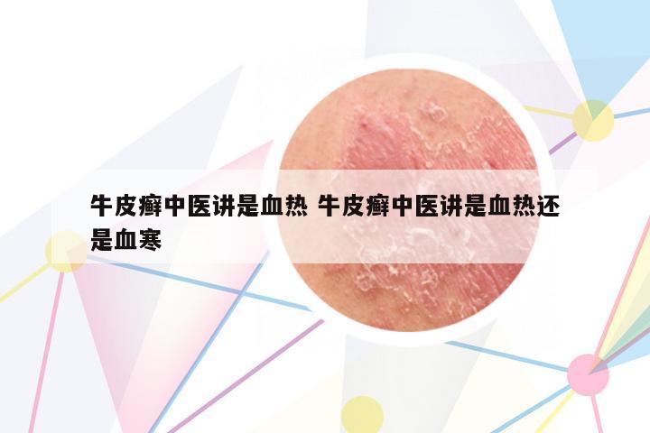 牛皮癬中醫(yī)講是血熱 牛皮癬中醫(yī)講是血熱還是血寒