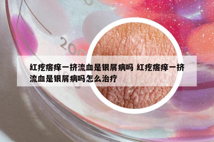 紅疙瘩癢一擠流血是銀屑病嗎 紅疙瘩癢一擠流血是銀屑病嗎怎么治療