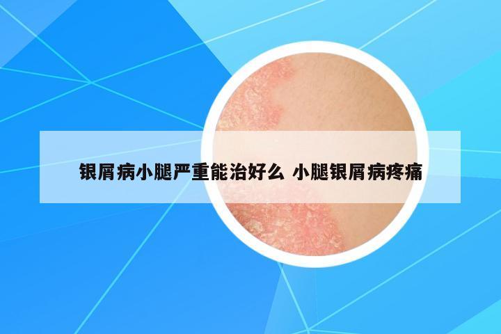銀屑病小腿嚴(yán)重能治好么 小腿銀屑病疼痛