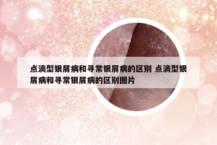 點滴型銀屑病和尋常銀屑病的區(qū)別 點滴型銀屑病和尋常銀屑病的區(qū)別圖片