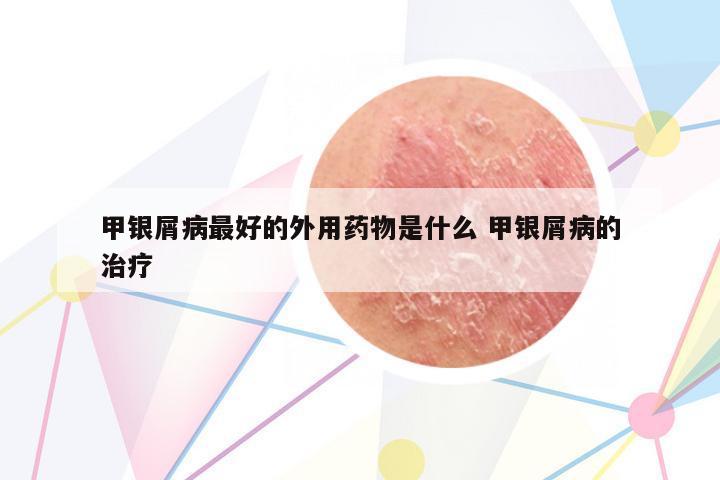 甲銀屑病最好的外用藥物是什么 甲銀屑病的治療
