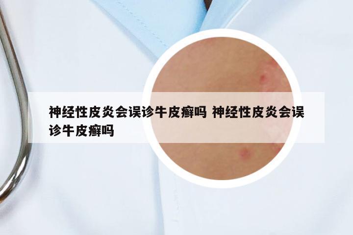 神經性皮炎會誤診牛皮癬嗎 神經性皮炎會誤診牛皮癬嗎